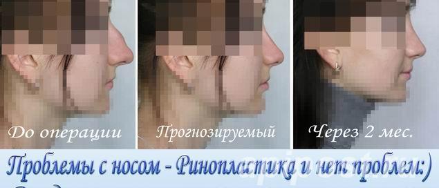 Ринопластика - изменить размер или форму носа. - Симферополь